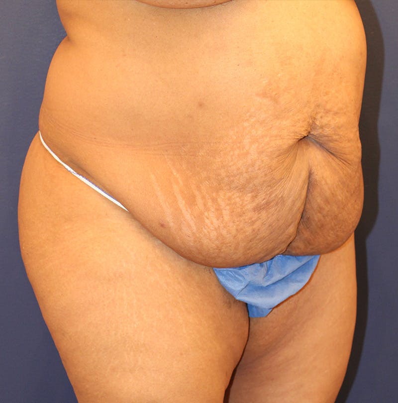 Tummy Tuck Before & After Gallery - Patient 770134 - Image 3