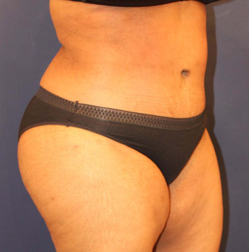Tummy Tuck Before & After Gallery - Patient 770134 - Image 4