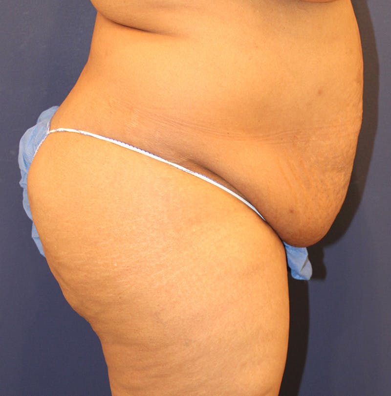 Tummy Tuck Before & After Gallery - Patient 770134 - Image 5