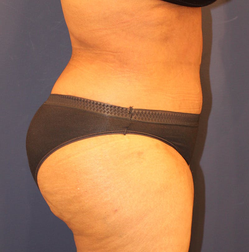 Tummy Tuck Before & After Gallery - Patient 770134 - Image 6