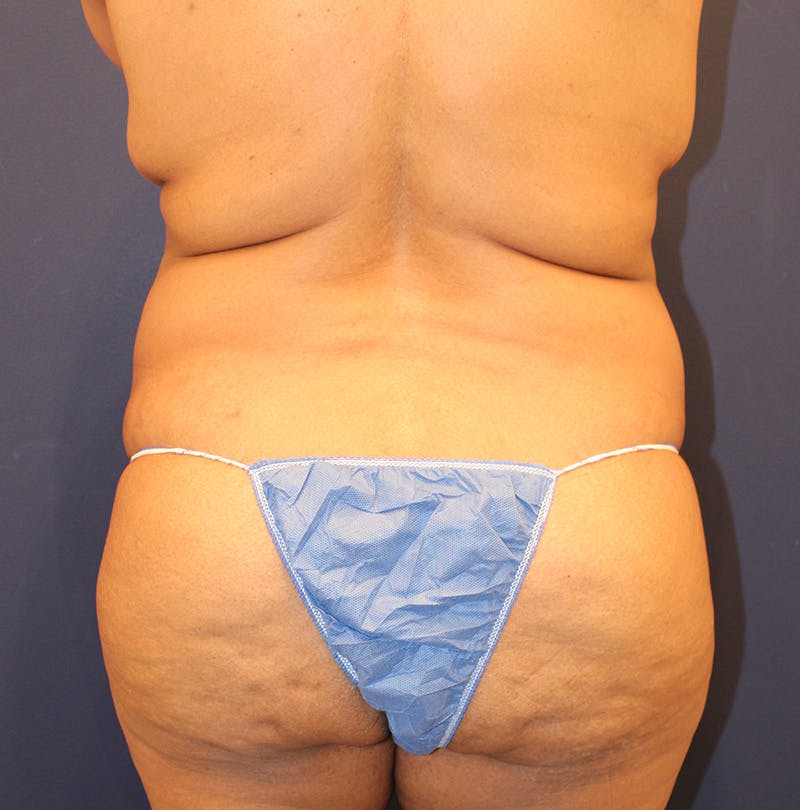Tummy Tuck Before & After Gallery - Patient 770134 - Image 7