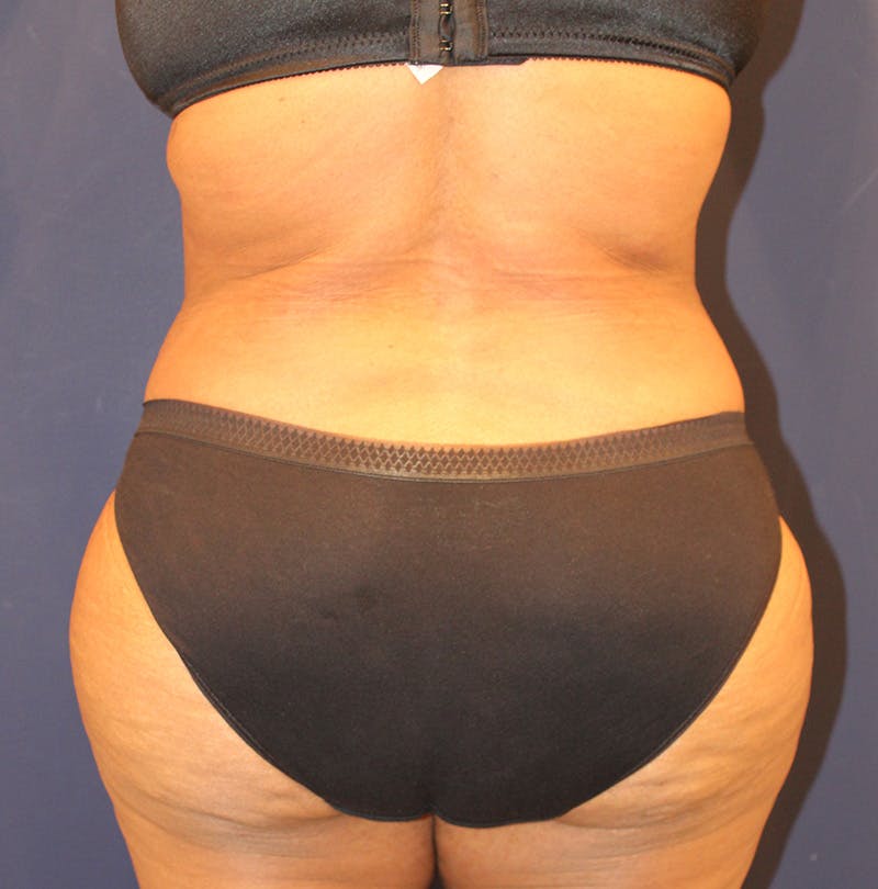 Tummy Tuck Before & After Gallery - Patient 770134 - Image 8