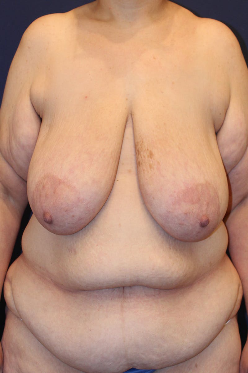 Massive Weight Loss Before & After Gallery - Patient 643835 - Image 1