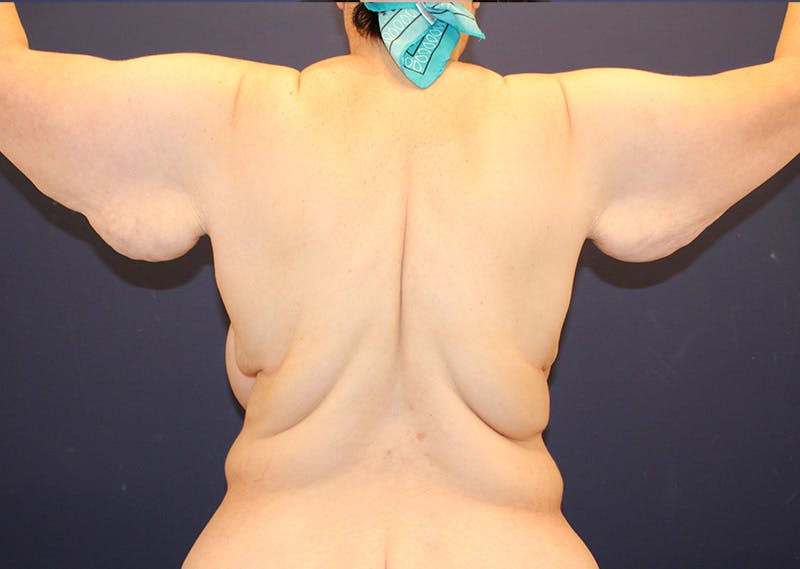 Arm Lift Before & After Gallery - Patient 970419 - Image 3