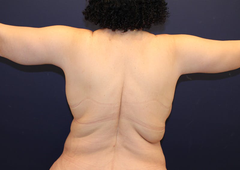 Arm Lift Before & After Gallery - Patient 970419 - Image 4