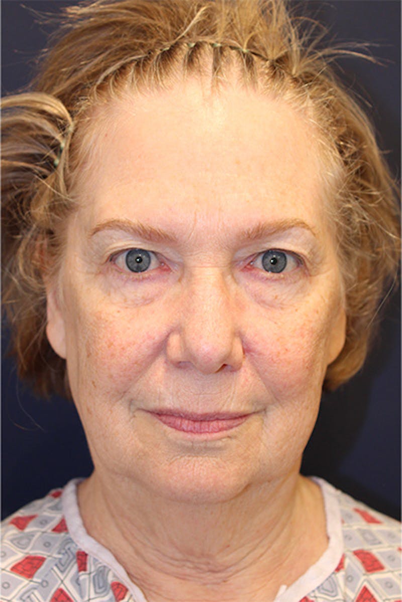 Facelift Before & After Gallery - Patient 258818 - Image 1