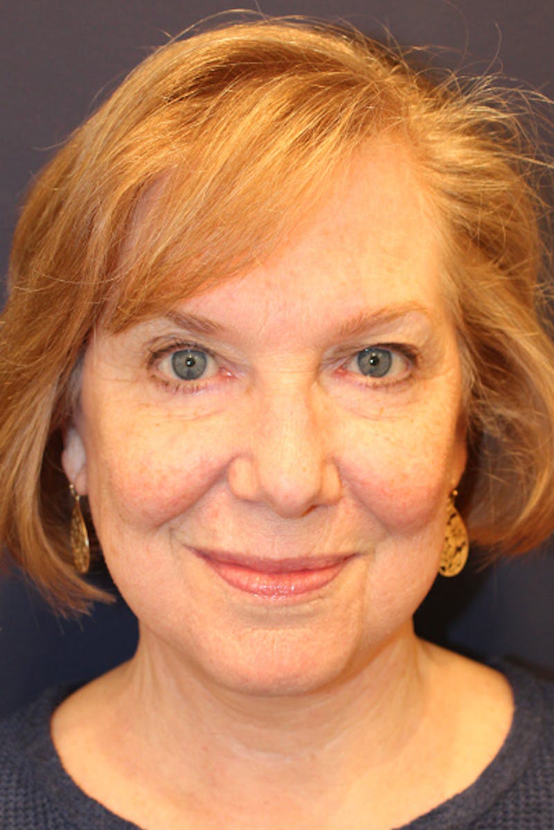 Facelift Before & After Gallery - Patient 258818 - Image 2