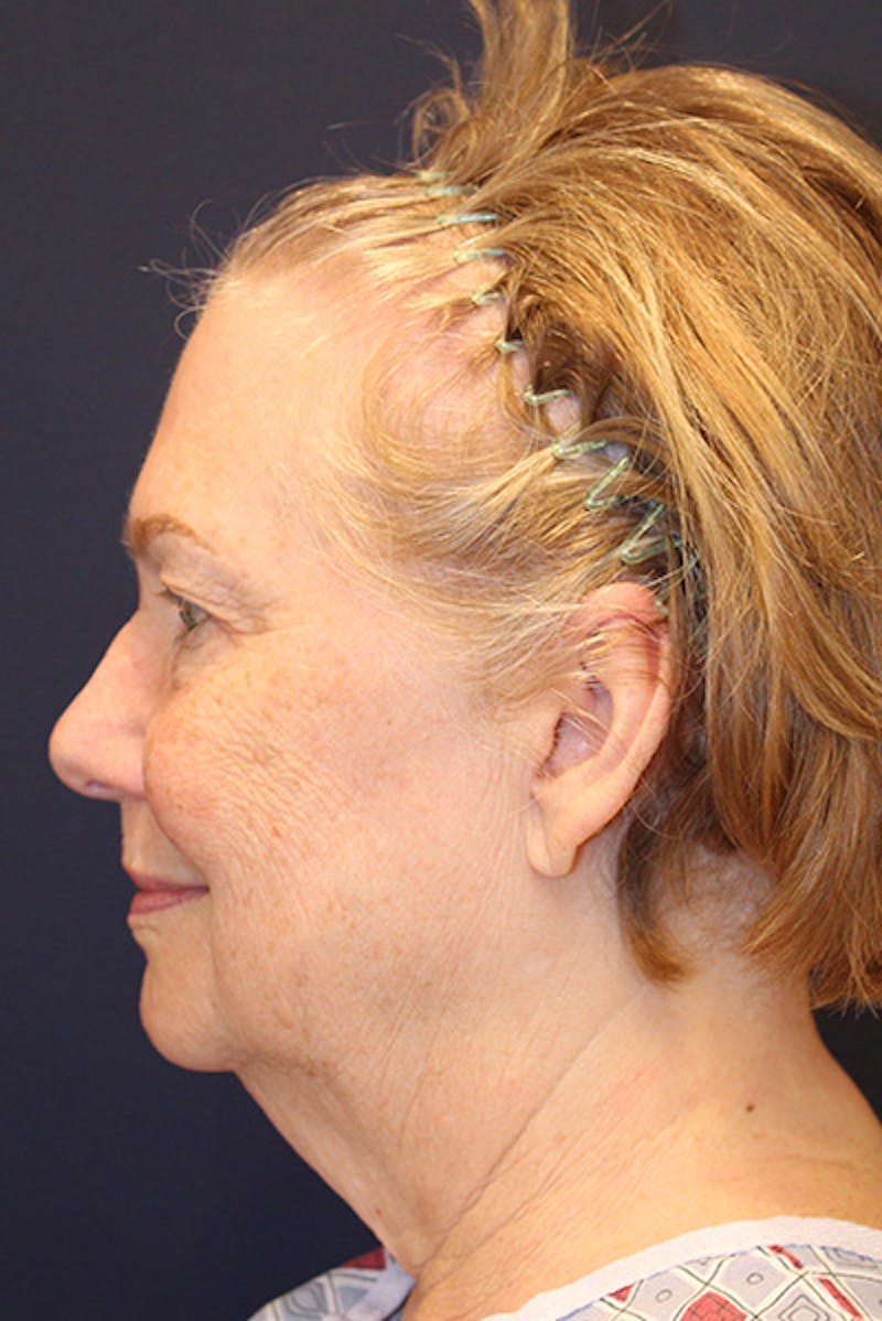 Facelift Before & After Gallery - Patient 258818 - Image 5