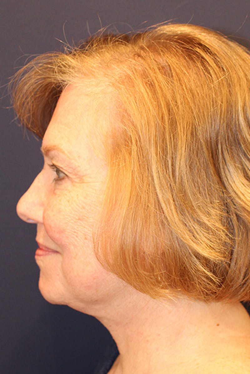 Facelift Before & After Gallery - Patient 258818 - Image 6