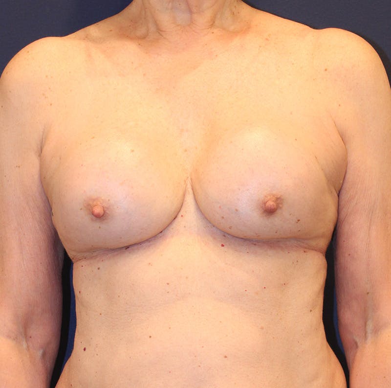 Breast Implant Revision Before & After Gallery - Patient 360092 - Image 1