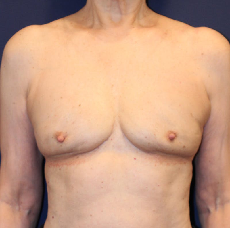 Breast Implant Revision Before & After Gallery - Patient 360092 - Image 2