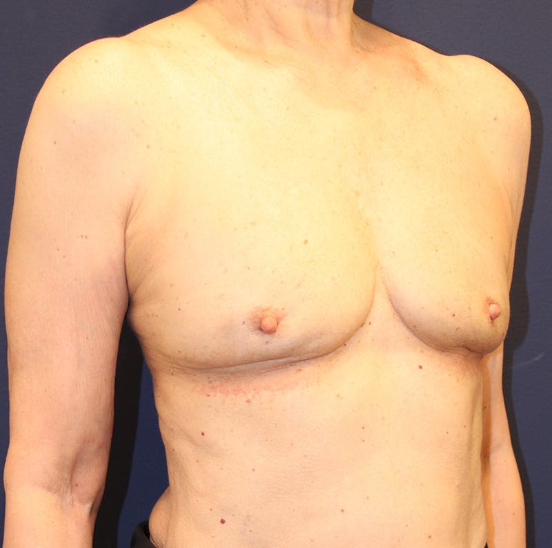 Breast Implant Revision Before & After Gallery - Patient 360092 - Image 4