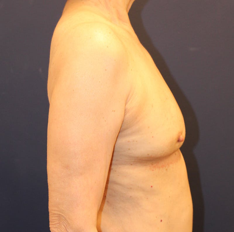 Breast Implant Revision Before & After Gallery - Patient 360092 - Image 6