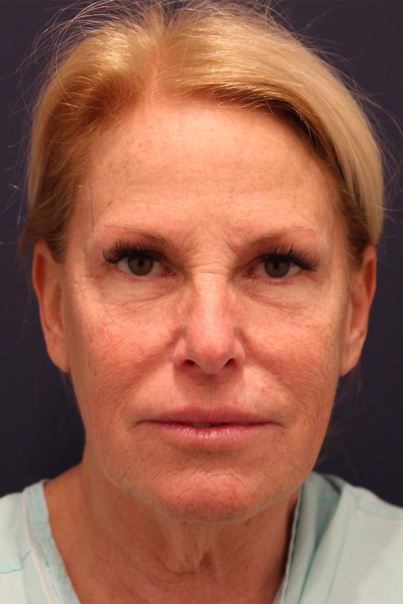 Facelift Before & After Gallery - Patient 100359 - Image 1