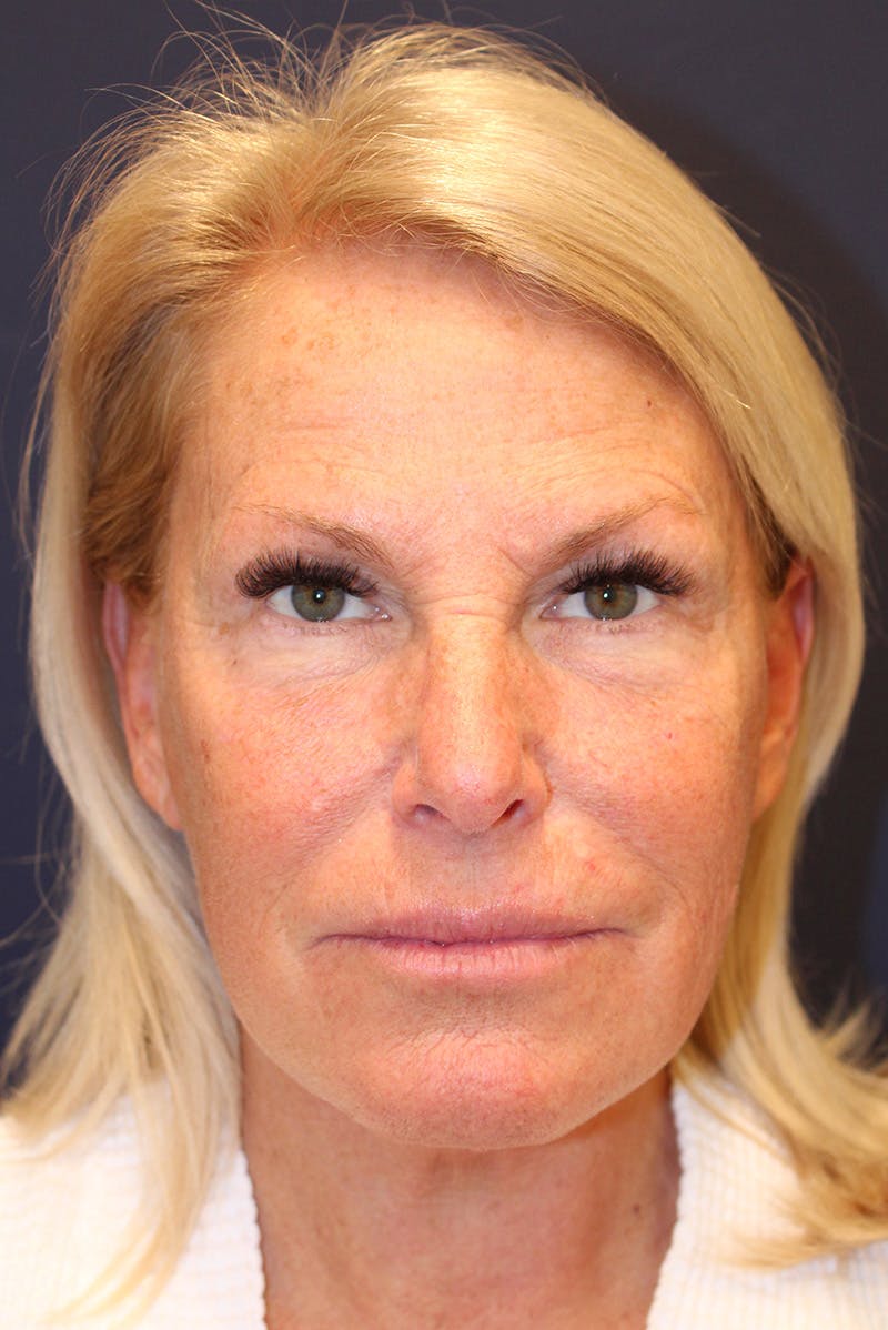 Facelift Before & After Gallery - Patient 100359 - Image 2