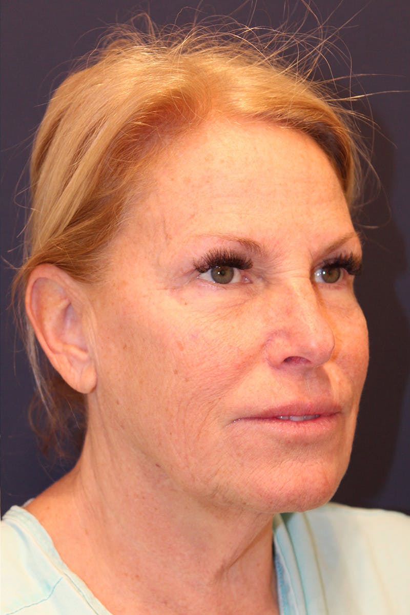 Facelift Before & After Gallery - Patient 100359 - Image 3