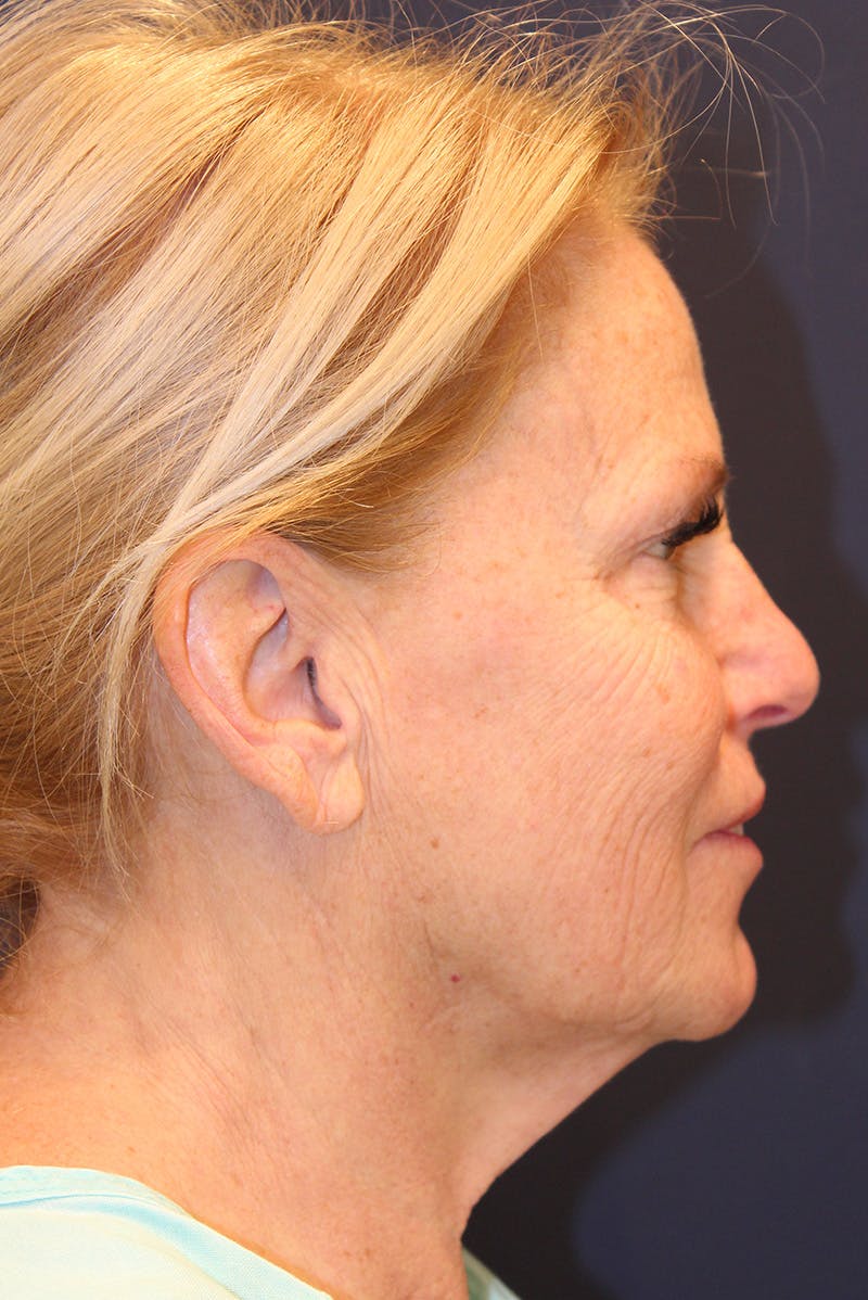 Facelift Before & After Gallery - Patient 100359 - Image 5
