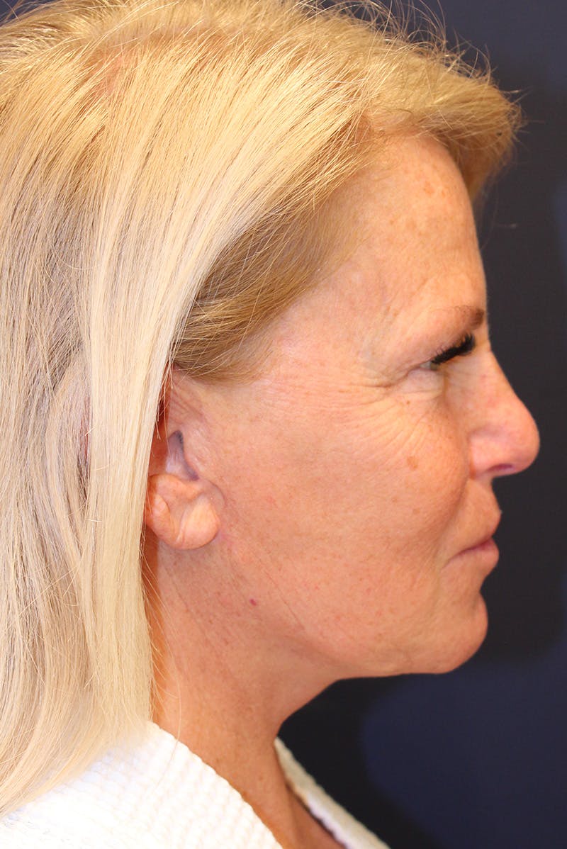 Facelift Before & After Gallery - Patient 100359 - Image 6