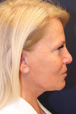 Facelift Before & After Gallery - Patient 100359 - Image 6