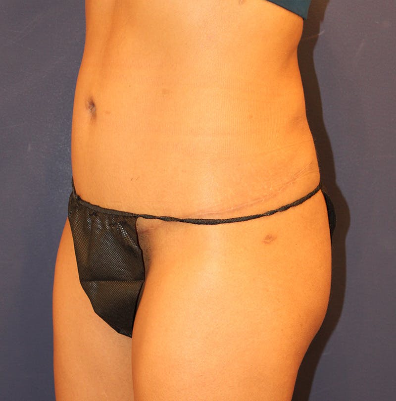 Tummy Tuck Before & After Gallery - Patient 354131 - Image 4