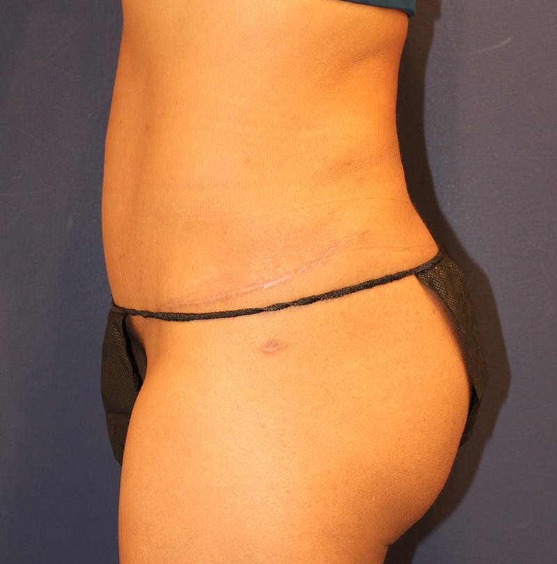 Tummy Tuck Before & After Gallery - Patient 354131 - Image 6