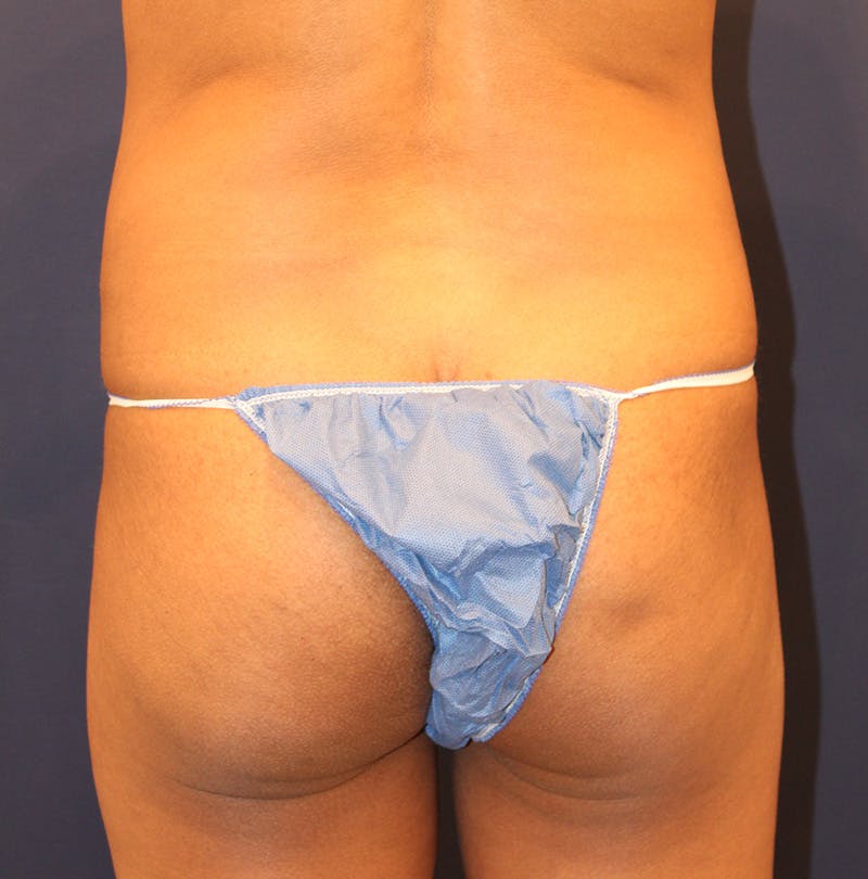 Tummy Tuck Before & After Gallery - Patient 354131 - Image 7