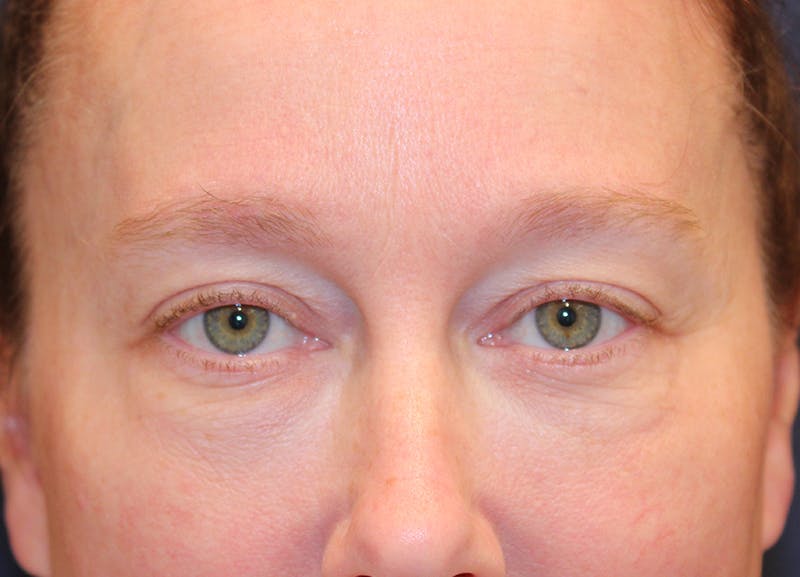 Eyelid Surgery Before & After Gallery - Patient 158765 - Image 1