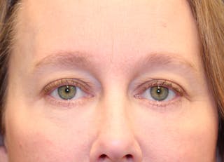 Eyelid Surgery Before & After Gallery - Patient 158765 - Image 2
