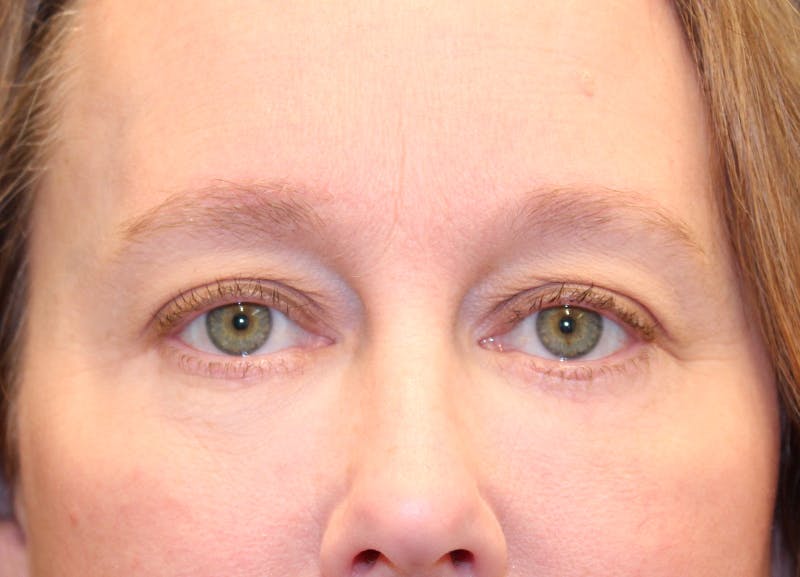 Eyelid Surgery Before & After Gallery - Patient 158765 - Image 2