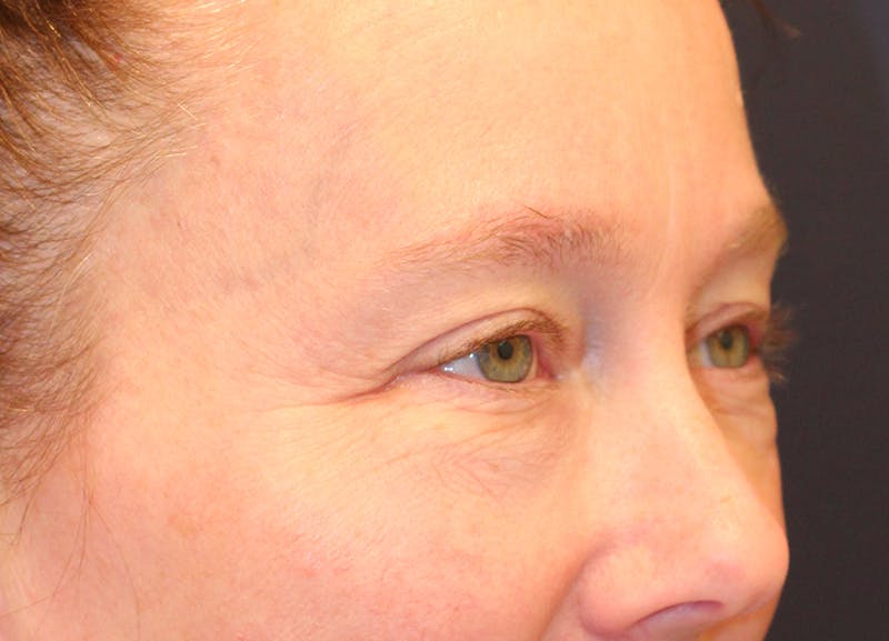 Eyelid Surgery Before & After Gallery - Patient 158765 - Image 3