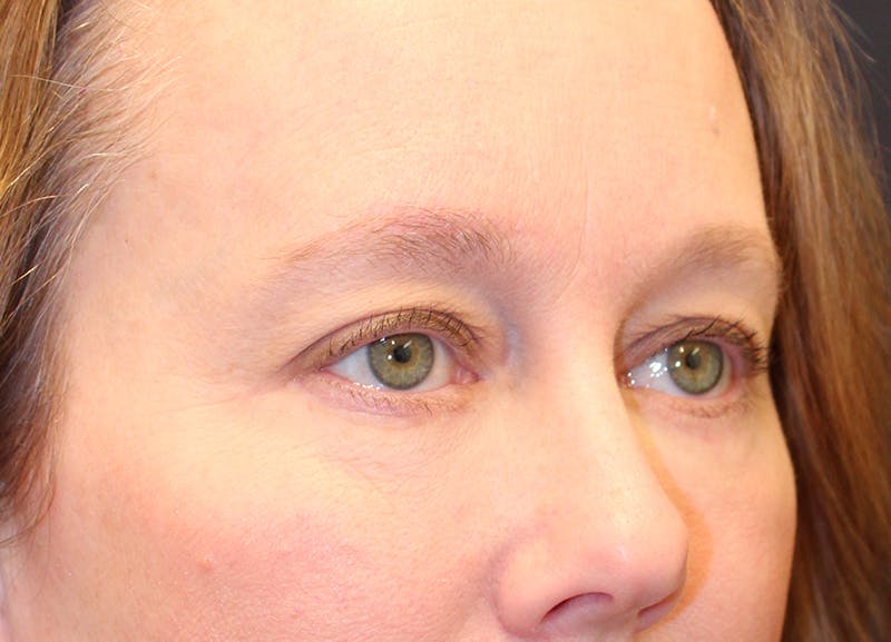 Eyelid Surgery Before & After Gallery - Patient 158765 - Image 4