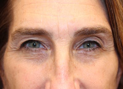 Eyelid Surgery Before & After Gallery - Patient 116220 - Image 1
