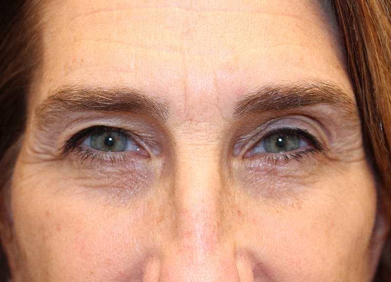 Eyelid Surgery Before & After Gallery - Patient 116220 - Image 1