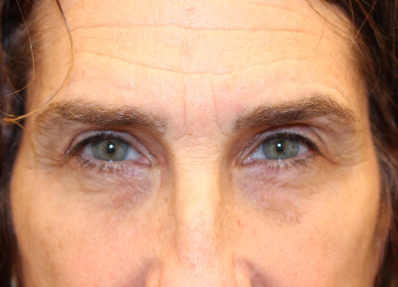 Eyelid Surgery Before & After Gallery - Patient 116220 - Image 2