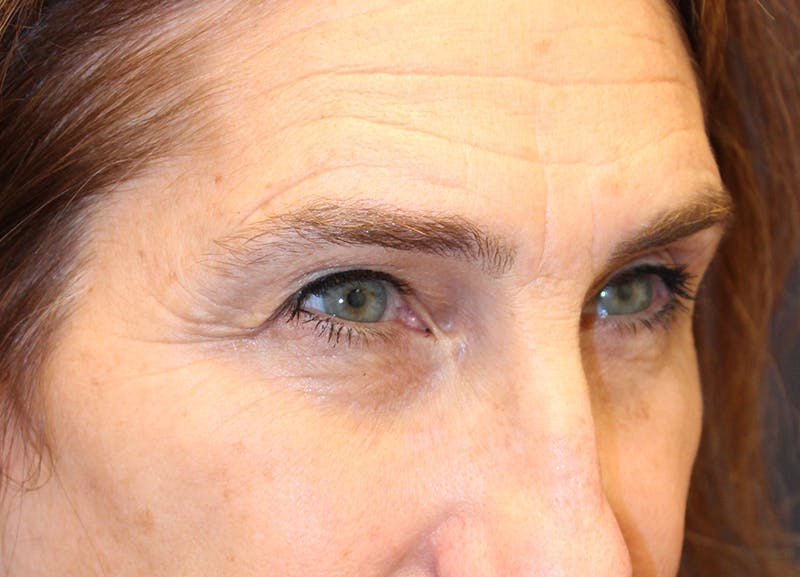 Eyelid Surgery Before & After Gallery - Patient 116220 - Image 3