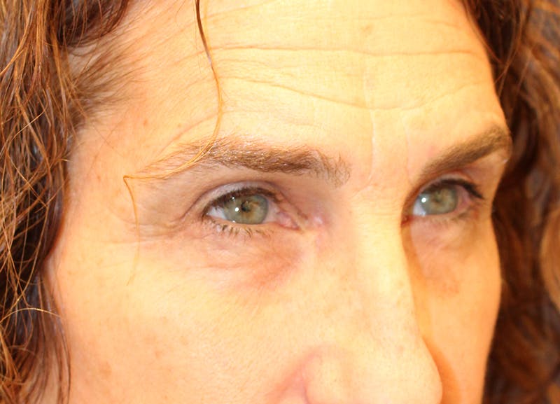 Eyelid Surgery Before & After Gallery - Patient 116220 - Image 4