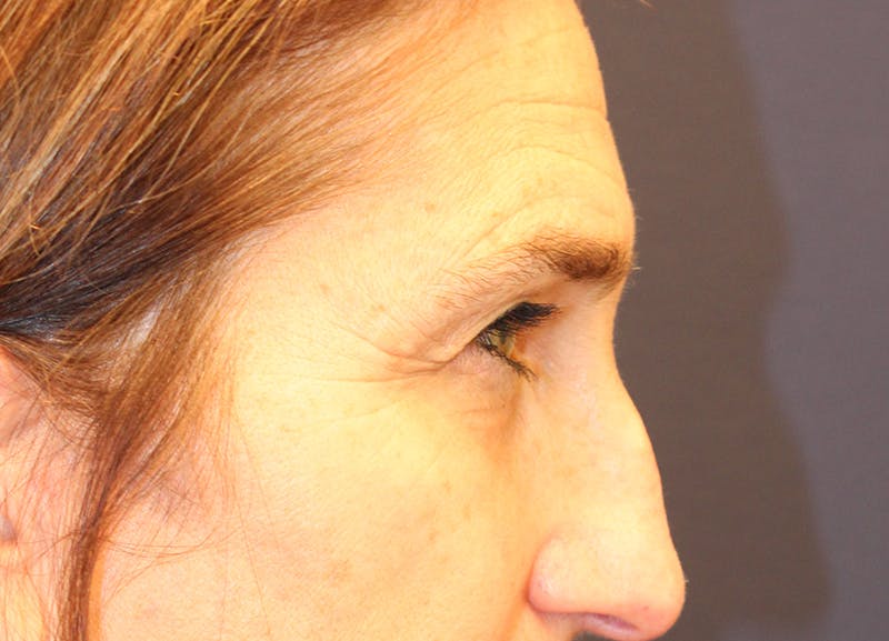 Eyelid Surgery Before & After Gallery - Patient 116220 - Image 5