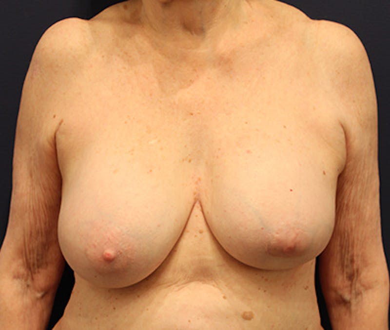 Breast Lift Before & After Gallery - Patient 252061 - Image 1