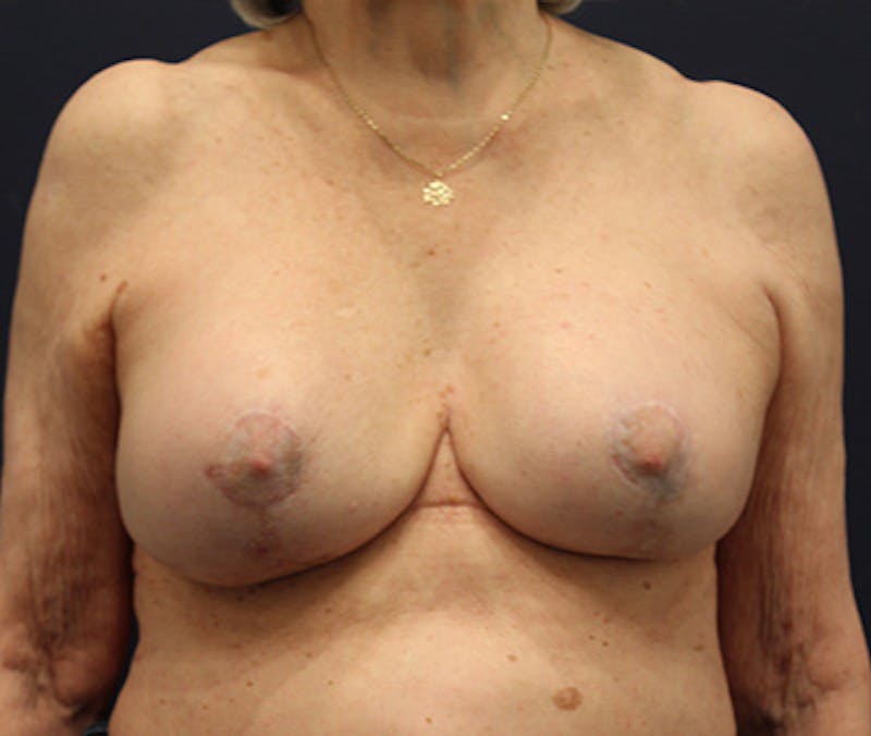 Breast Lift Before & After Gallery - Patient 252061 - Image 2