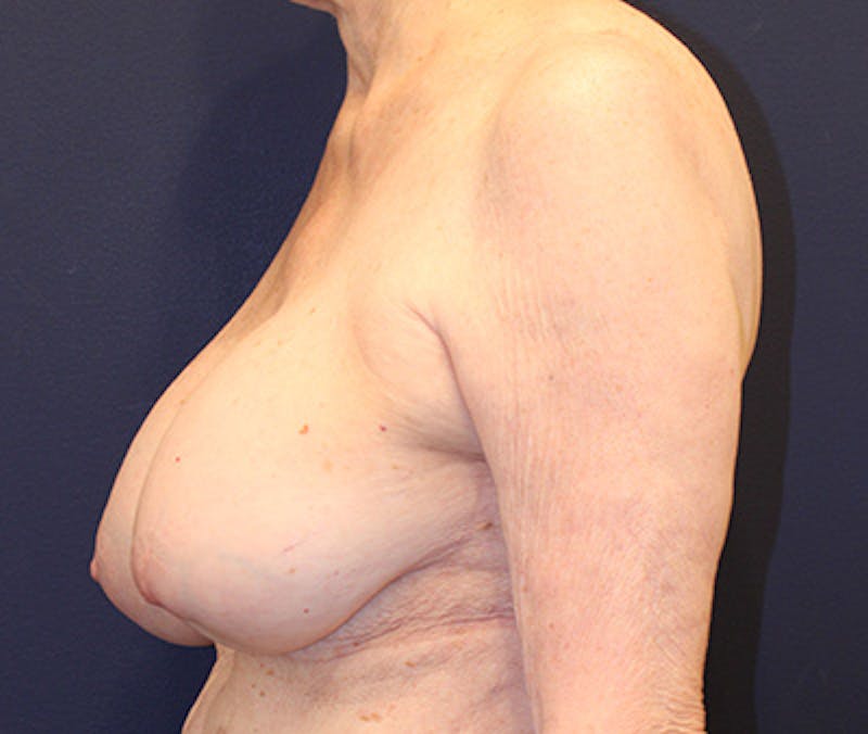 Breast Lift Before & After Gallery - Patient 252061 - Image 5