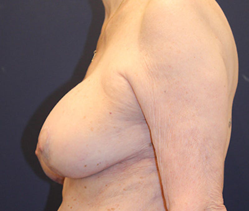 Breast Lift Before & After Gallery - Patient 252061 - Image 6