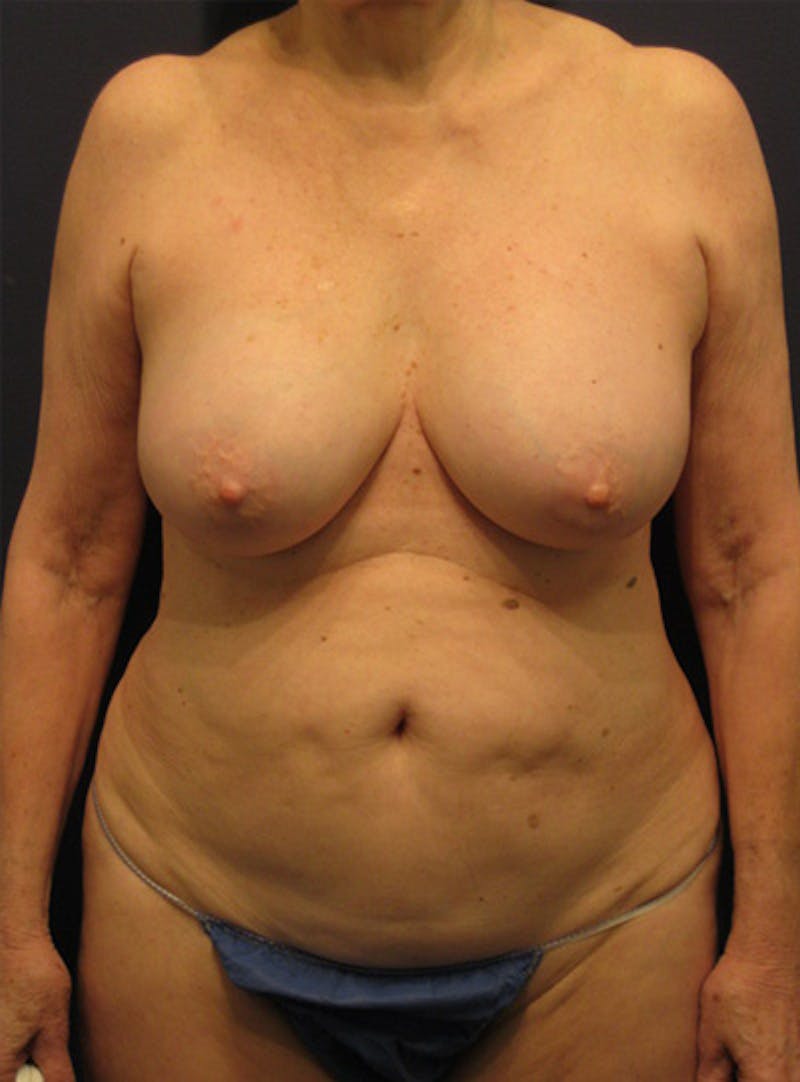 Breast Removal/Explant Before & After Gallery - Patient 420398 - Image 1