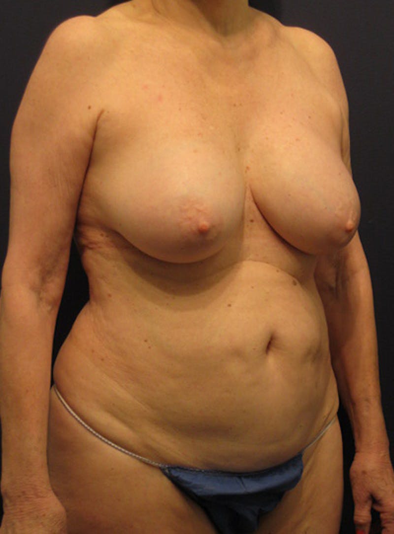 Mommy Makeover Before & After Gallery - Patient 302244 - Image 3