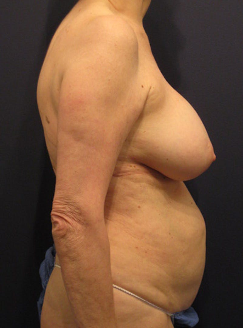 Breast Removal/Explant Before & After Gallery - Patient 420398 - Image 5