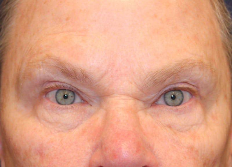 Eyelid Surgery Before & After Gallery - Patient 330660 - Image 1