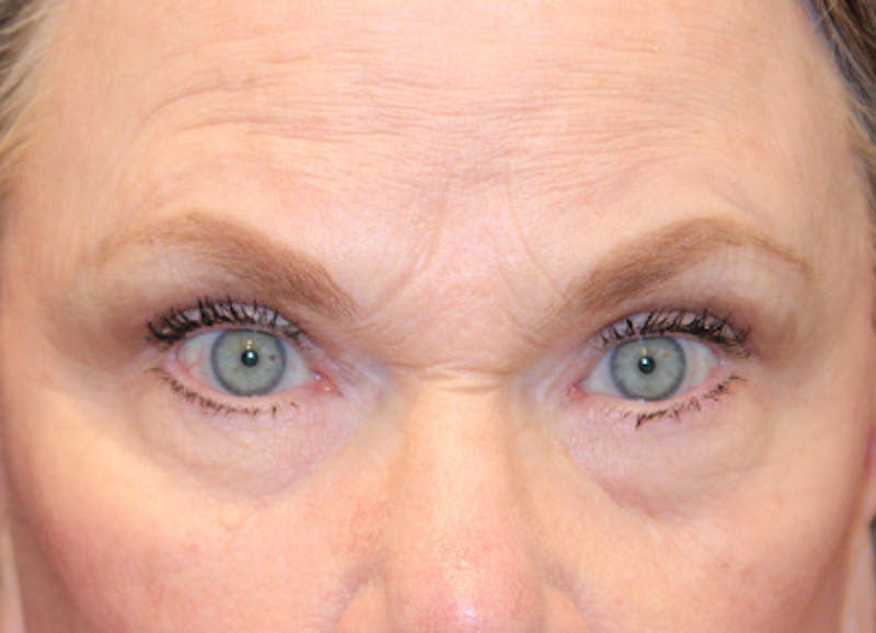 Eyelid Surgery Before & After Gallery - Patient 330660 - Image 2