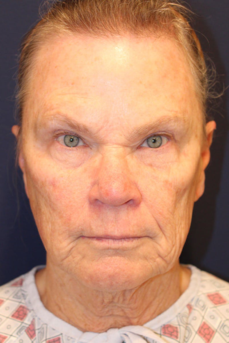 Facelift Before & After Gallery - Patient 731045 - Image 1