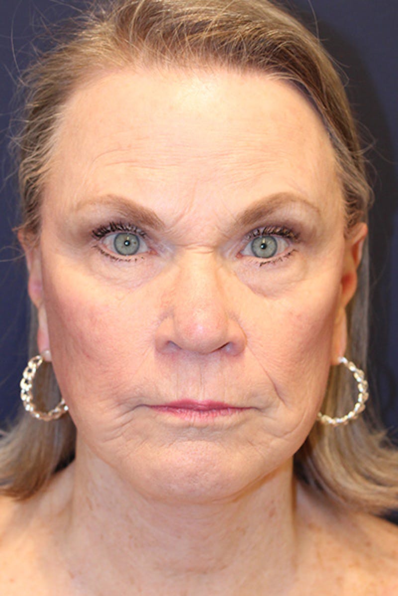 Facelift Before & After Gallery - Patient 731045 - Image 2