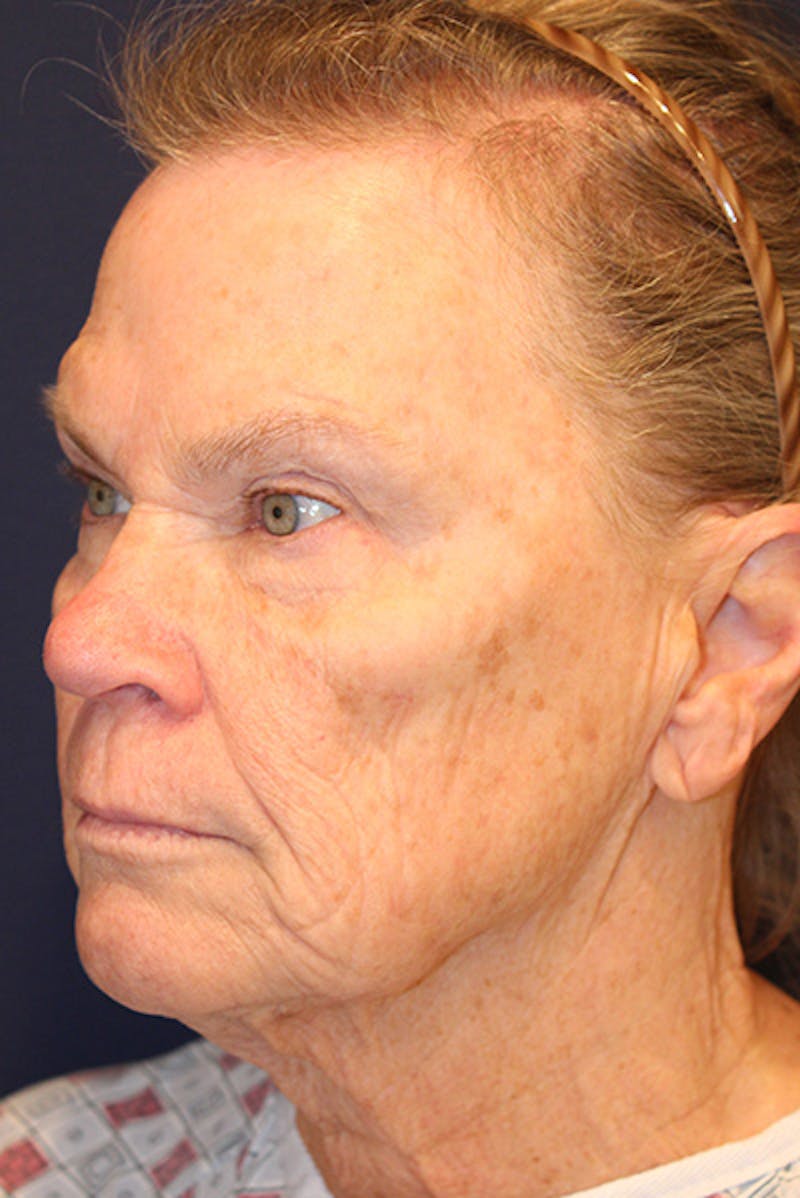 Facelift Before & After Gallery - Patient 731045 - Image 3