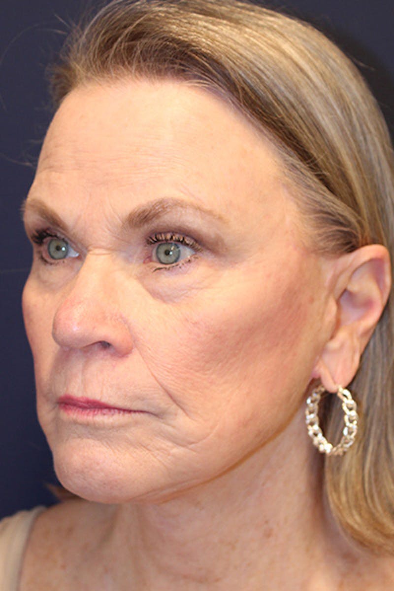 Facelift Before & After Gallery - Patient 731045 - Image 4